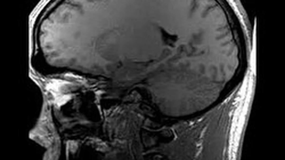 How AI Is Improving MRI Technology
