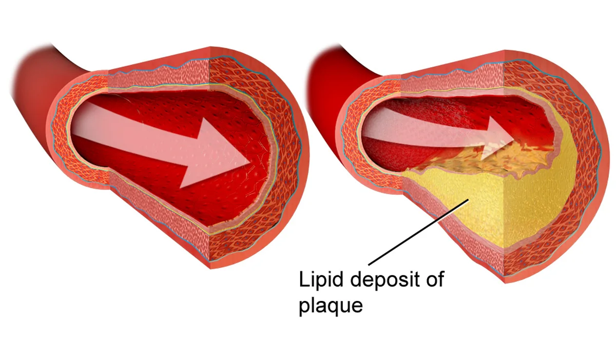 Coronary Artery Disease (CAD)