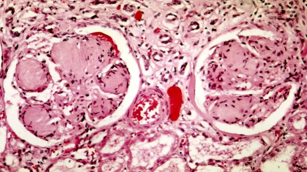 Diabetic Nephropathy