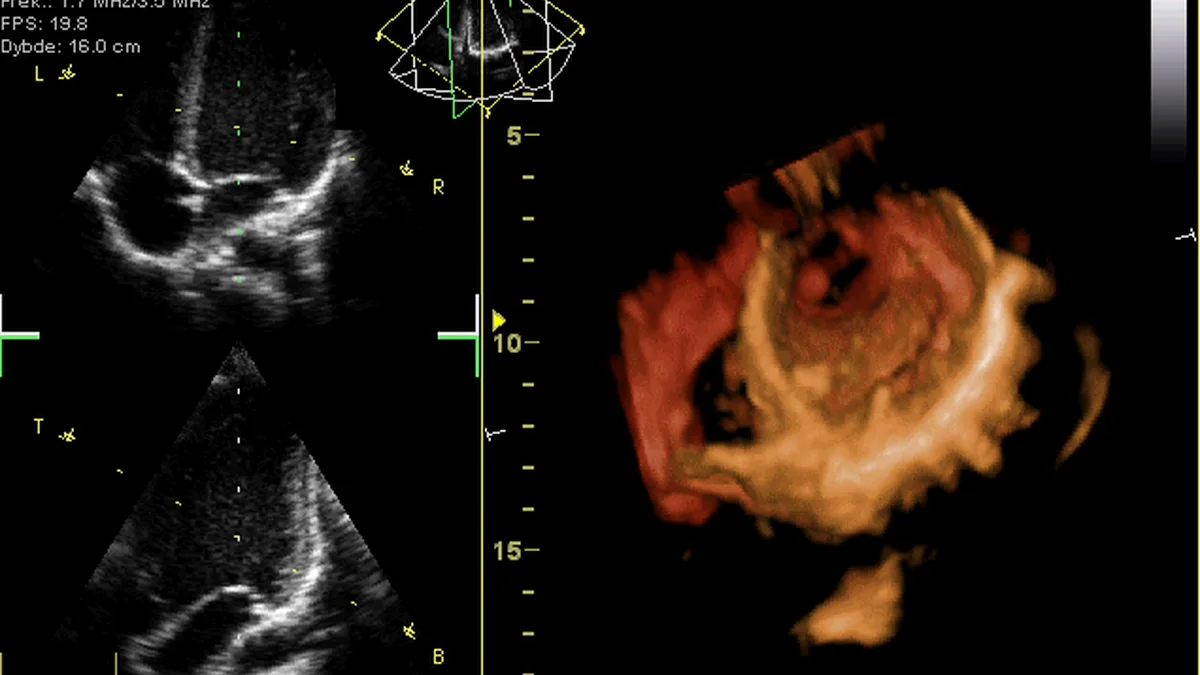 Echocardiogram