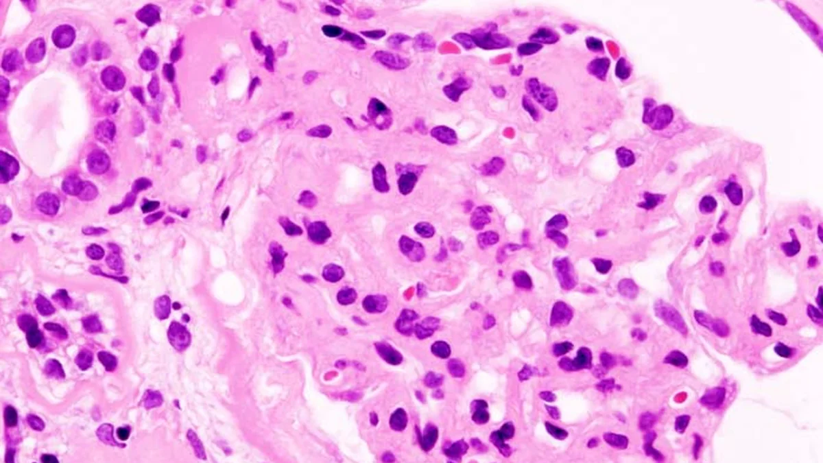 Nephrotic Syndrome