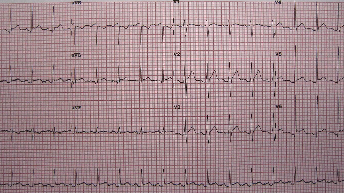 Pericarditis